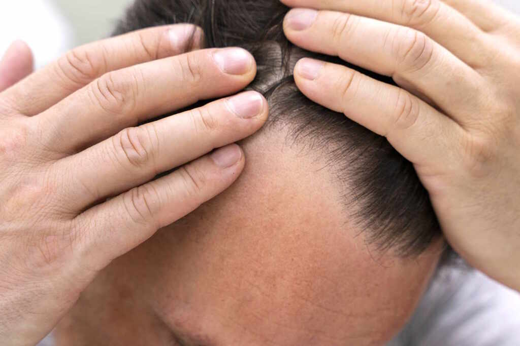 Hair loss