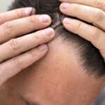 Hair loss
