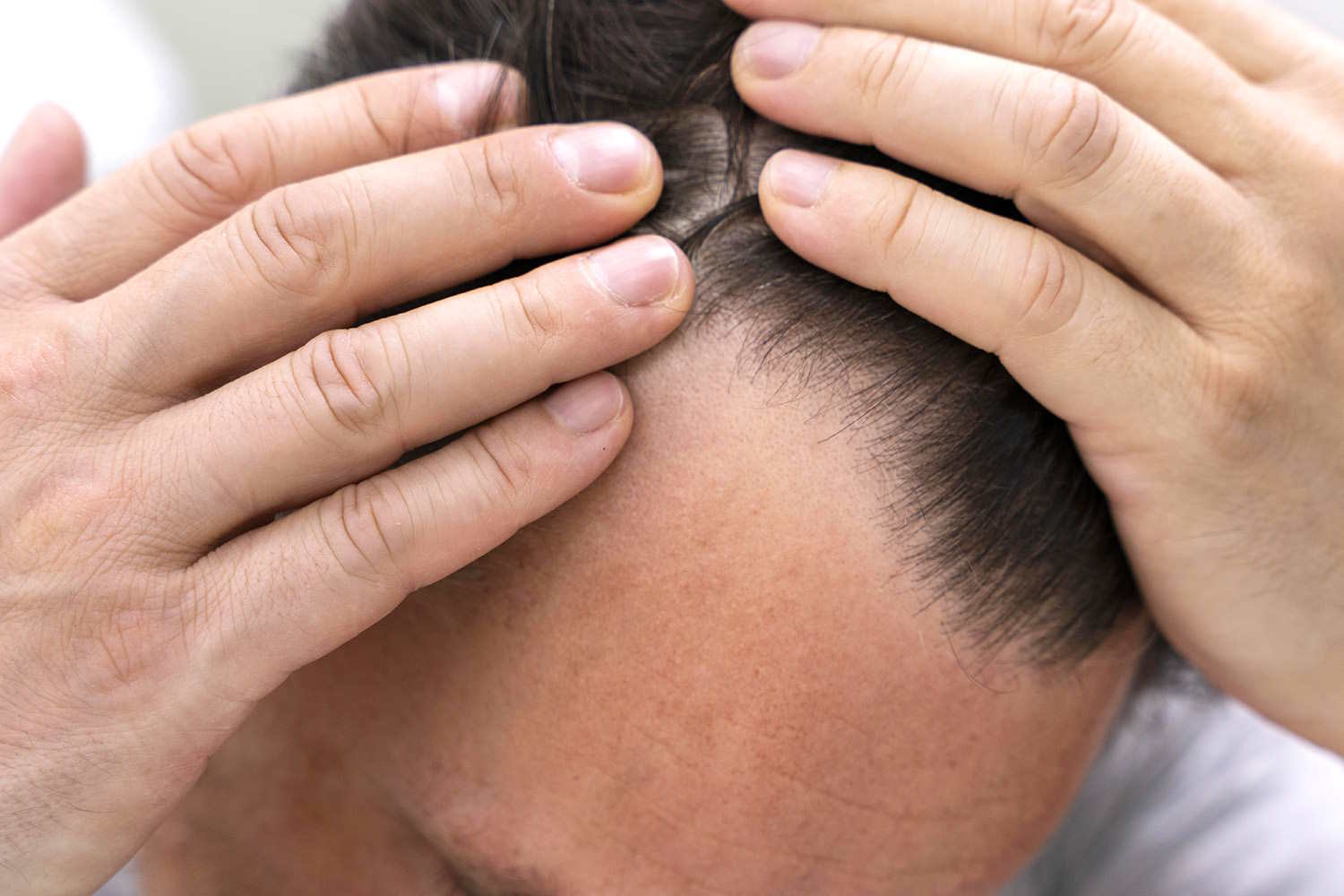 Hair loss