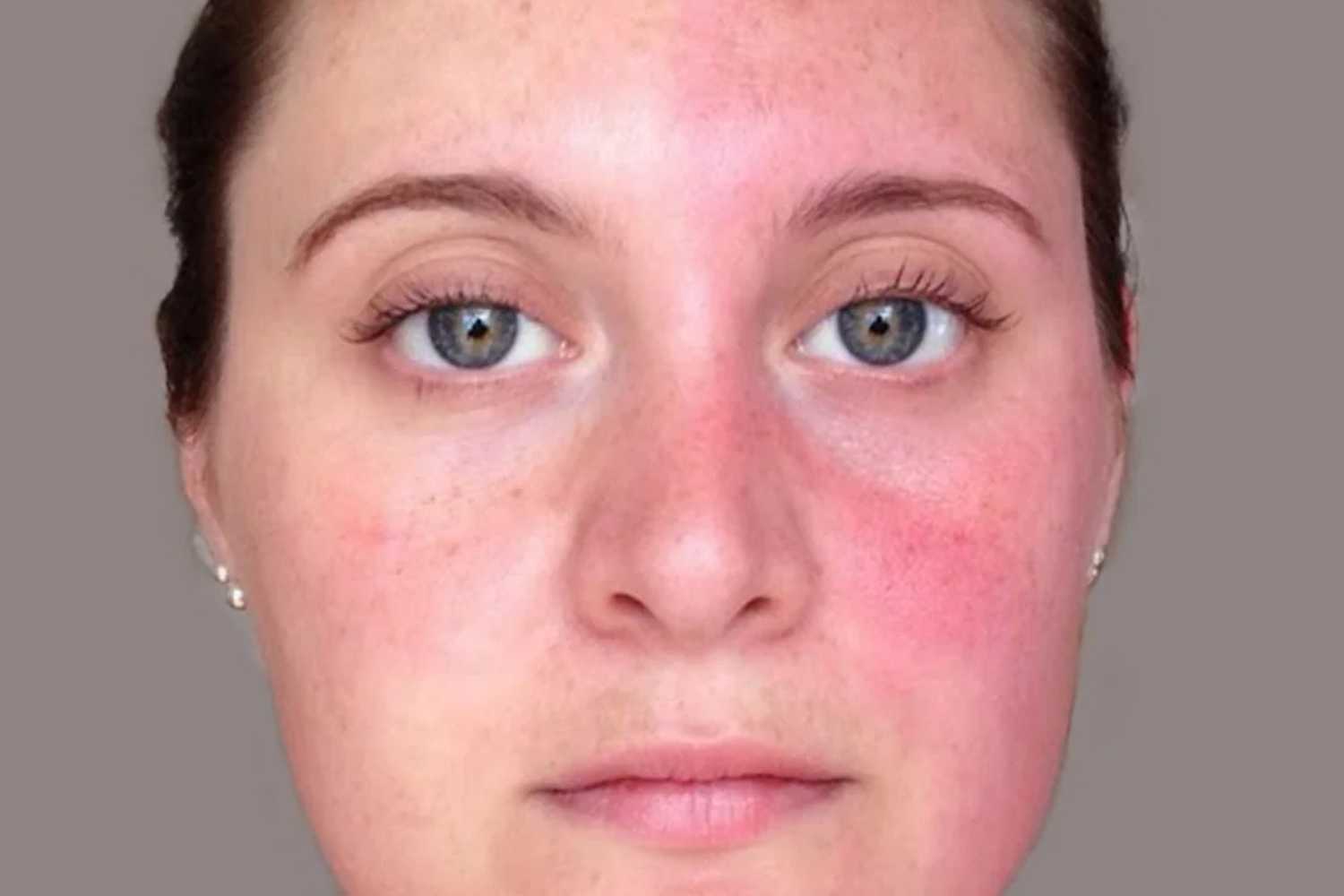 Harlequin syndrome